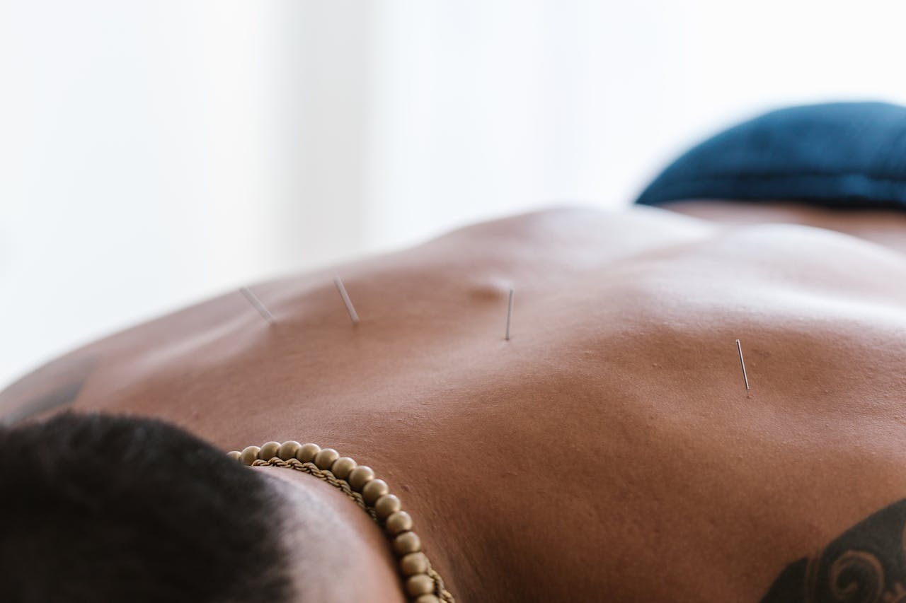 Acupuntura Estética: Rejuvenescimento Natural da Pele